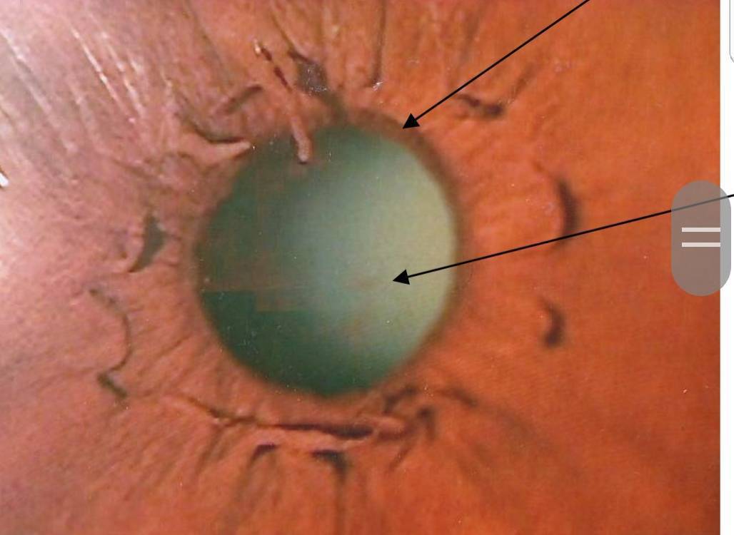 眼科醫師洪啟庭表示，瞳孔膜多數在1歲內會完全消失，但仍有20%成人的眼球上可見不規則的殘餘瞳孔膜（箭頭處），大多不會影響視力。圖／洪啟庭醫師提供