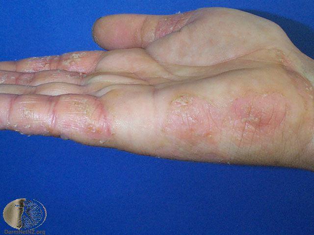 接觸刺激物質反覆發作在手部的異位性皮膚炎。 Photo Credit：Derma...