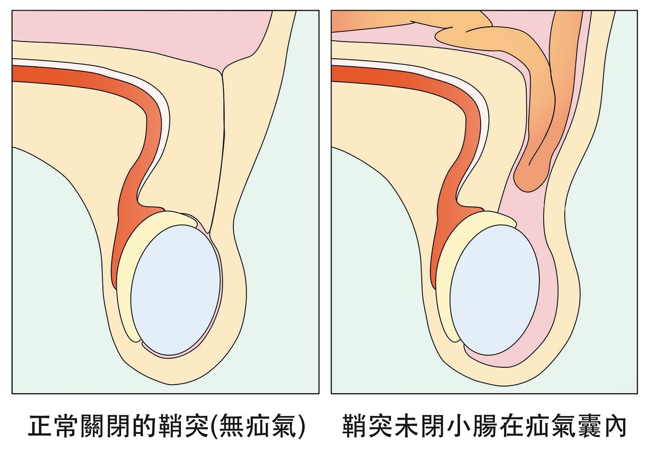 正常關閉的鞘突(無疝氣) 鞘突未閉小腸在疝氣囊內