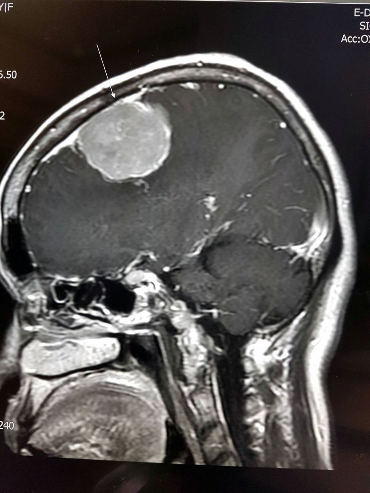62歲婦人因顱內長了4公分大的腦膜瘤，導致記憶力衰退。圖／義大大昌醫院提供