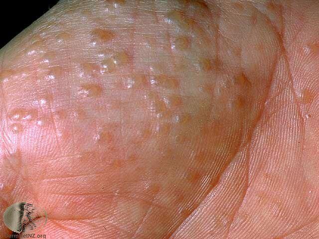 你是汗皰疹還是富貴手 富貴手如何根治 保養與預防 皮膚 科別 元氣網