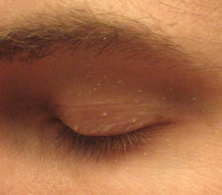 粟粒腫（Milia），圖片來源：wikipedia
