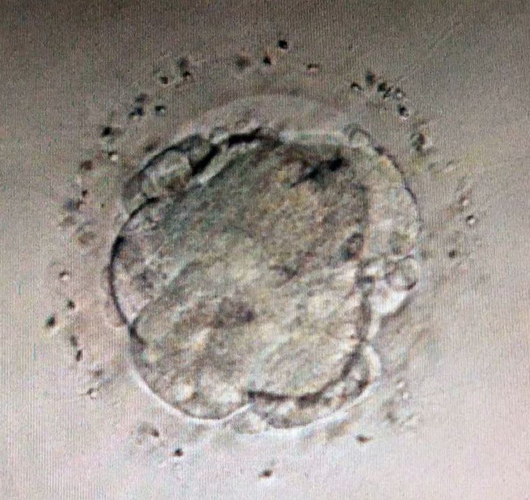 高雄長庚醫院取捐贈者的卵子製成人工胚胎（見圖）植入不孕症患者子宮，讓他們也有機會...