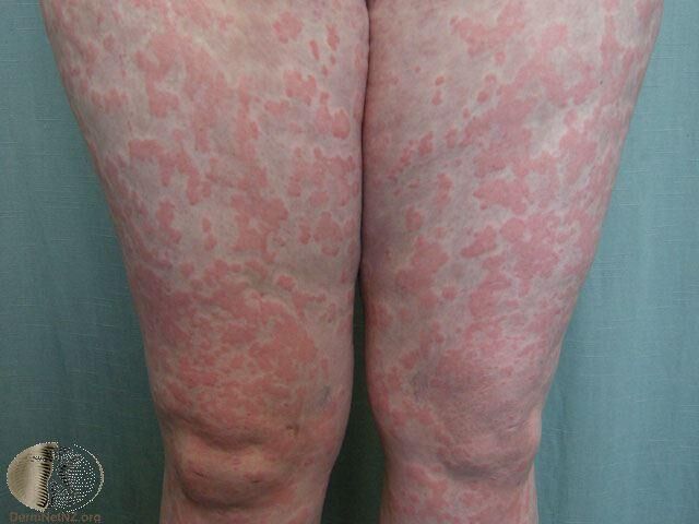 在腿部的蕁麻疹，界限明顯、紅色隆起的斑塊。Photo Credit：DermaN...