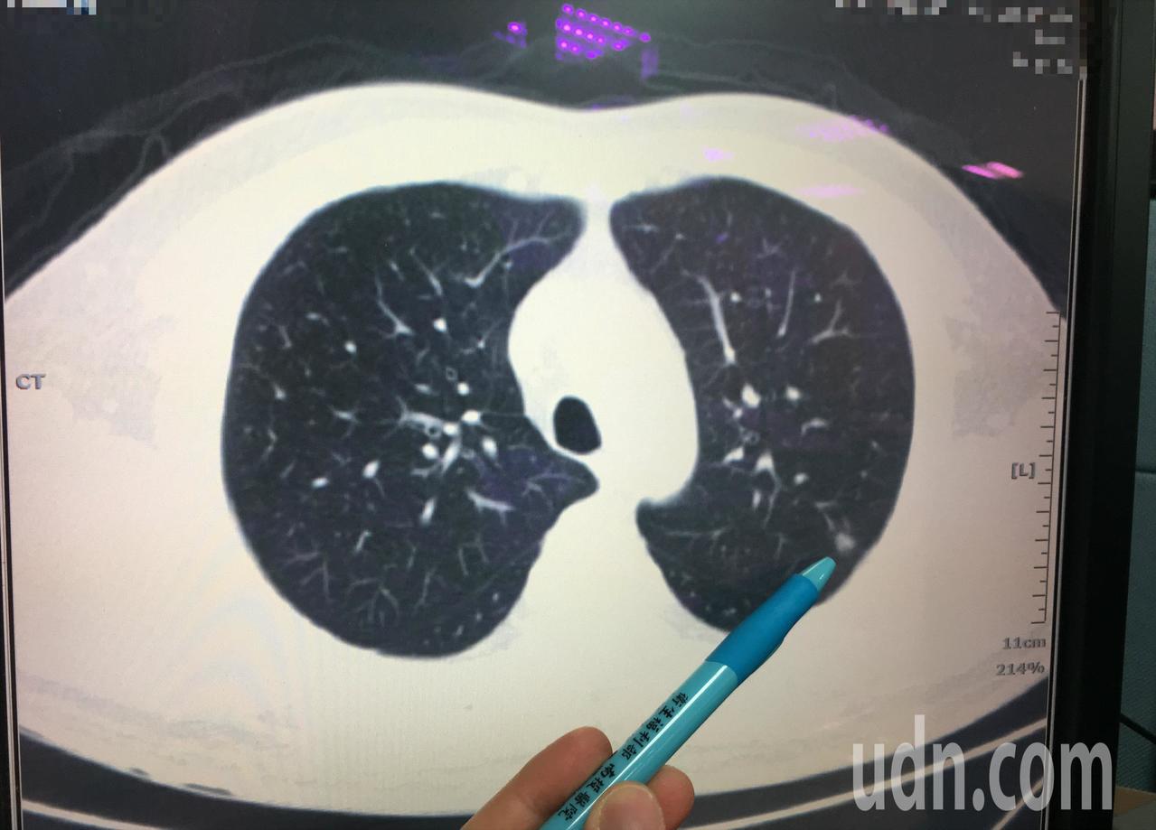 廖男經LDCT檢出左上肺部分有0.7和0.4公分結節，切片檢查確診是肺癌第一期。圖／南投醫院提供
