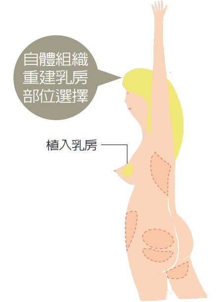 自體組織重建乳房部位選擇<br />繪圖／豆寶