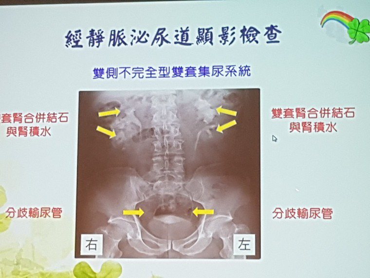 50歲男子泌尿道發炎並有結石，檢查出有四顆腎。記者修瑞瑩／翻攝