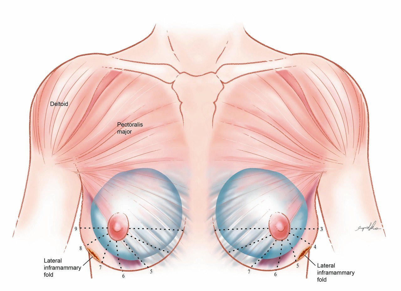 乳房整形示意圖：
由乳房兩側外下側緣開4至5公分切口，可完整撥離乳房、矽膠與莢膜的空間，疤痕隱藏在乳房外側下緣。