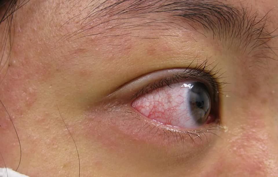麻疹病例亦有結膜炎等眼睛紅的症狀。