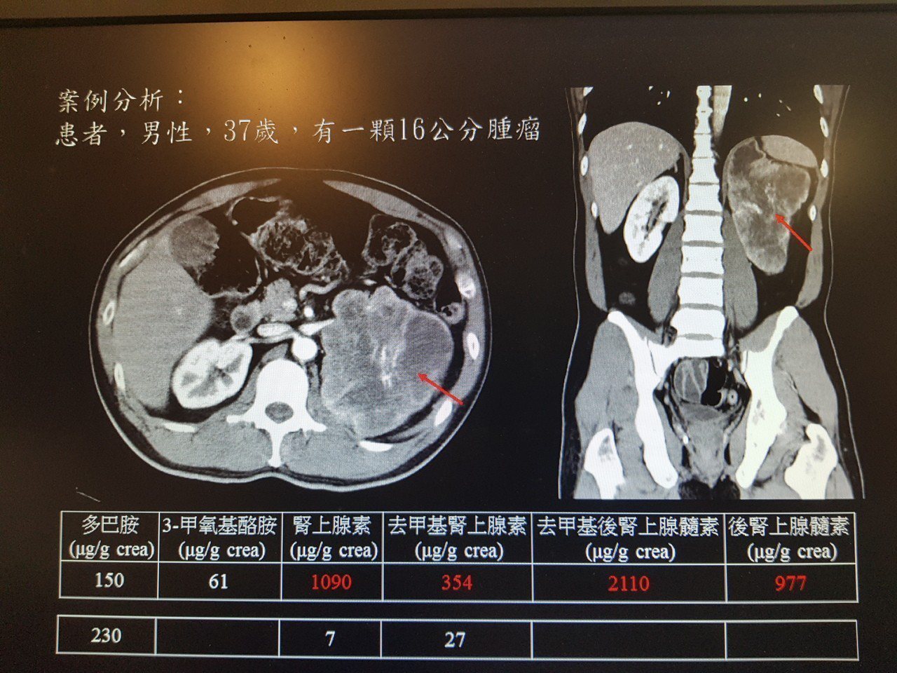 37歲男子腎上腺長了16公分大的嗜鉻細胞腫瘤 記者修瑞瑩/翻攝