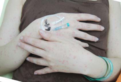 麻疹會引起手部皮疹等症狀。圖／新北市衛生局提供