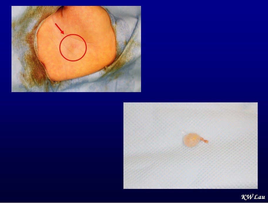 12歲小男童右手手掌出現一個小腫塊(左上)，經手術取出白色囊狀物(右下)後症狀改善。圖／書田診所提供