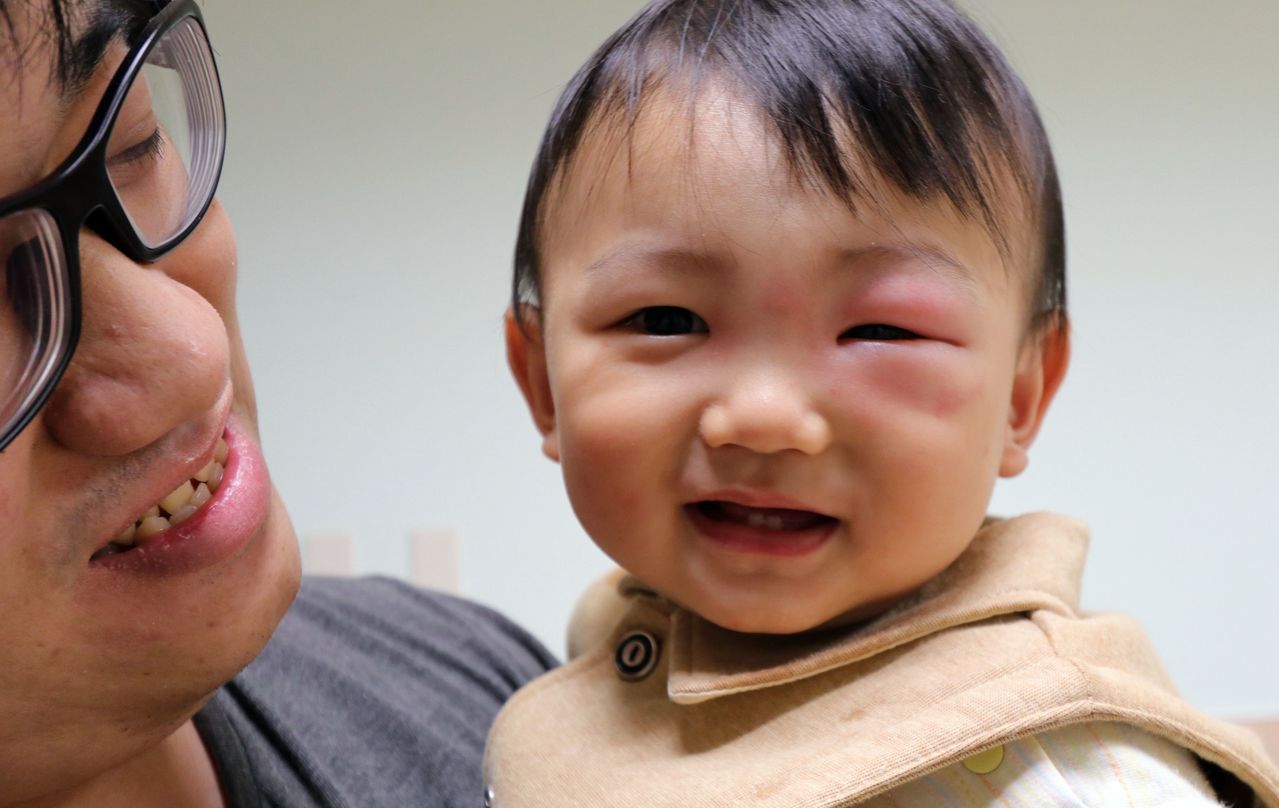 簡姓男嬰（右）左眼遭蚊子叮咬，腫得像麵龜，緊急送醫治療。圖／家長提供