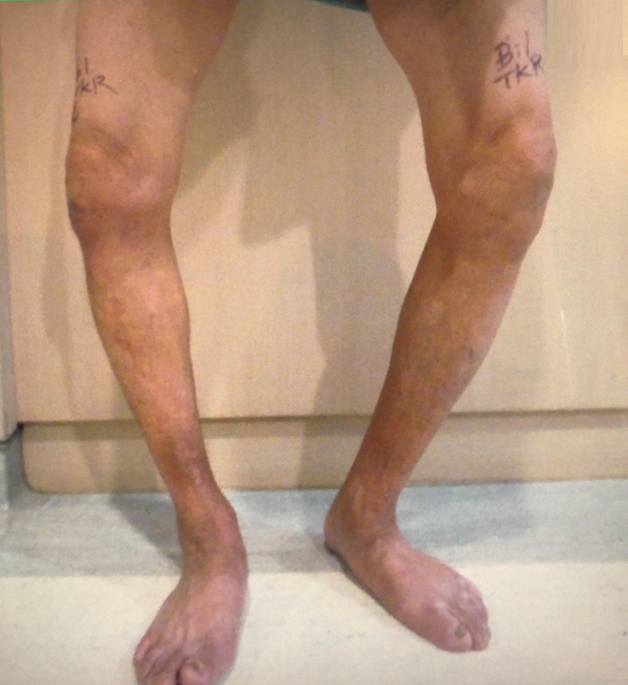 老翁雙膝內側軟骨磨損，雙腳呈現嚴重的O型腿。圖／大千綜合醫院提供