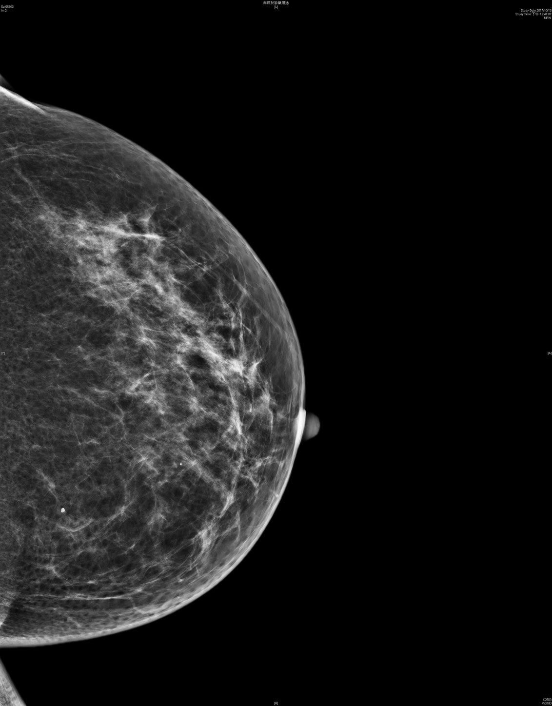 此為正常的乳房攝影影像。圖／阮綜合提供