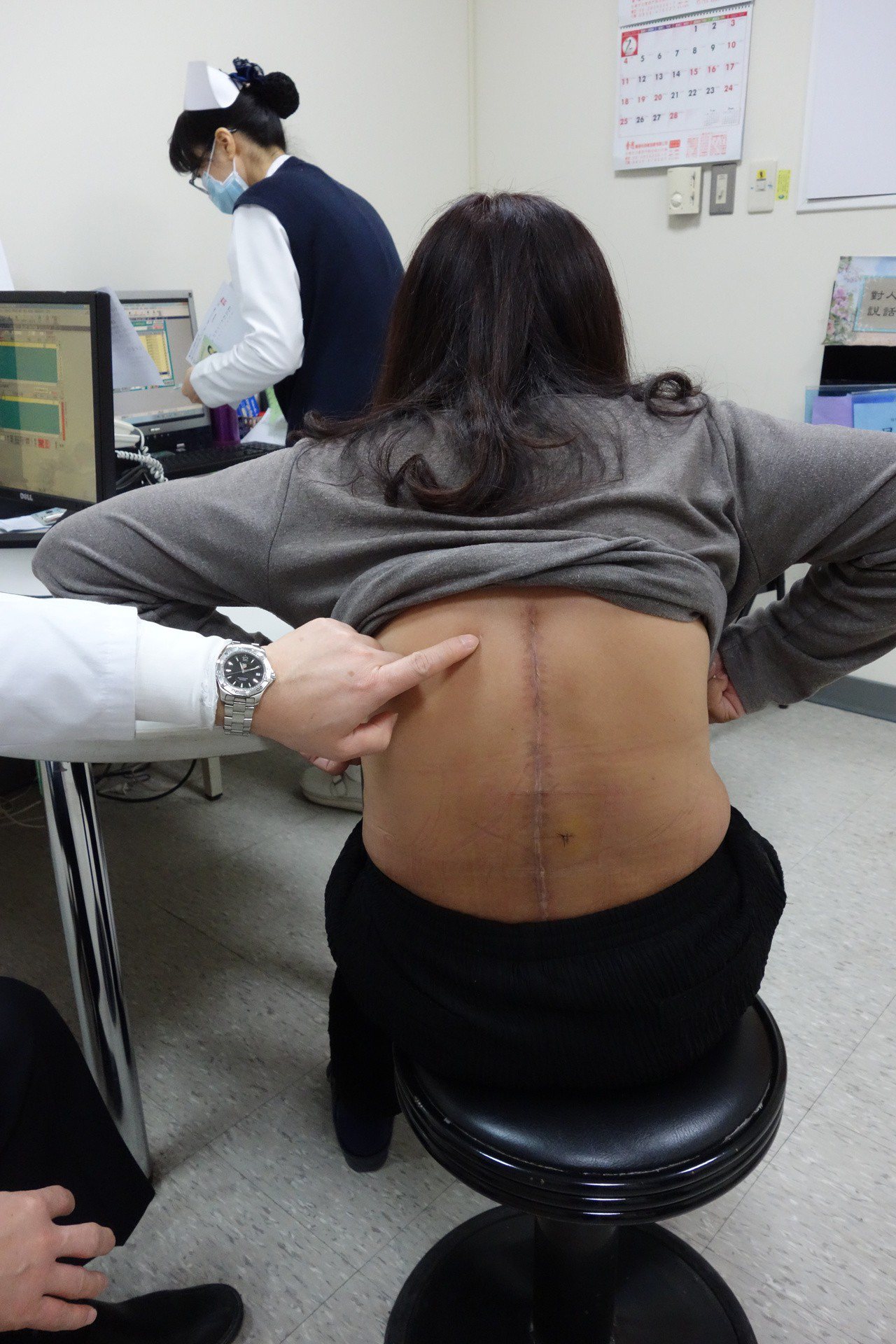 陳姓婦人背部原本的手術傷口。圖／大林慈濟醫院提供