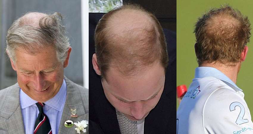 令英國王室都困擾的髮量問題，英國查爾斯王儲（左）威廉王子（中）哈利王子（圖片取自網路）