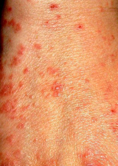 疥瘡患者皮膚出現紅斑丘疹。圖／取自維基百科
