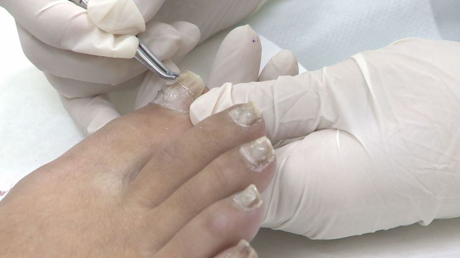 一名從事櫃姐二十多年的42歲女性，因為長期久站，導致腳趾甲發生嚴重甲溝炎。攝影／王彥鈞