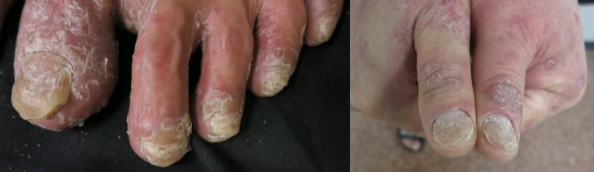 指甲黃黃、灰灰、醜醜不見得是「灰指甲」，可能是關節炎警訊。圖／中山大學附設醫院皮膚科主任蕭玉屏提供