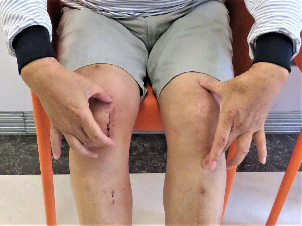 蔡姓患者說，右膝（左）進行「機器人關節置換術」傷口比左膝的全膝置換（右）來得小。...