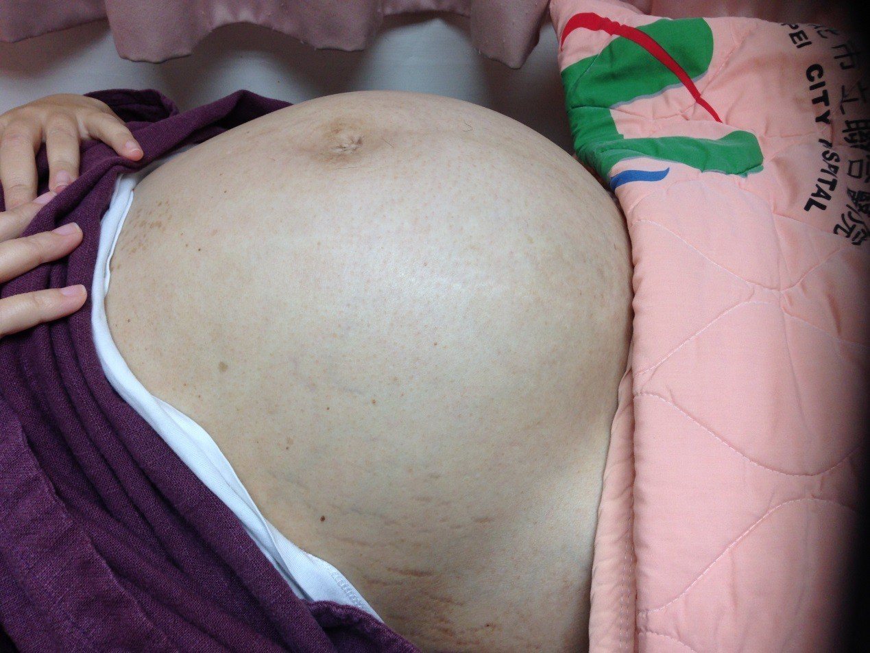 患者腹部有一顆直徑超過30公分、重達6公斤子宮肌瘤。資料照片