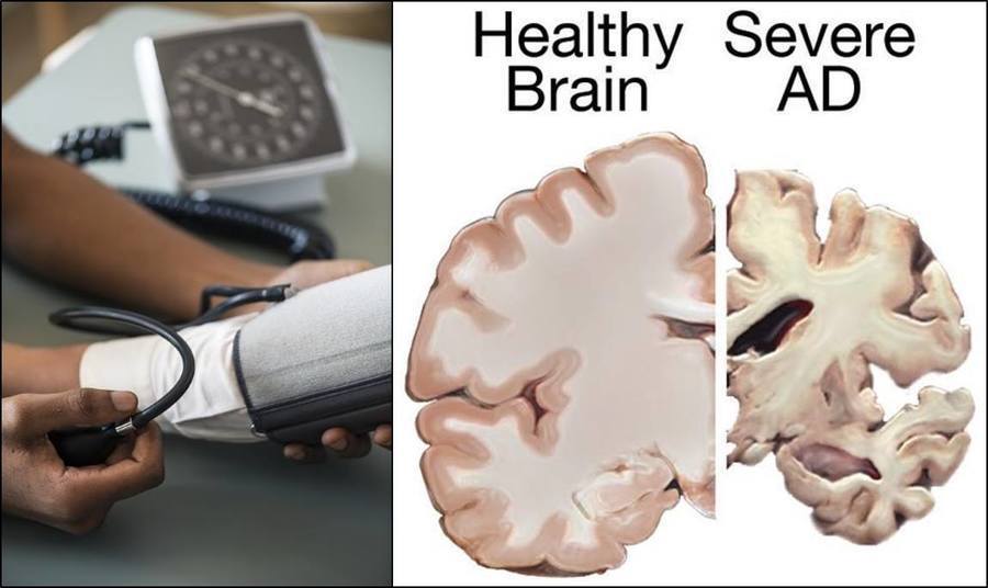 研究顯示，高血壓與阿茲海默症有顯著關係。（photo by Wikimedia Commons, Pixabay）