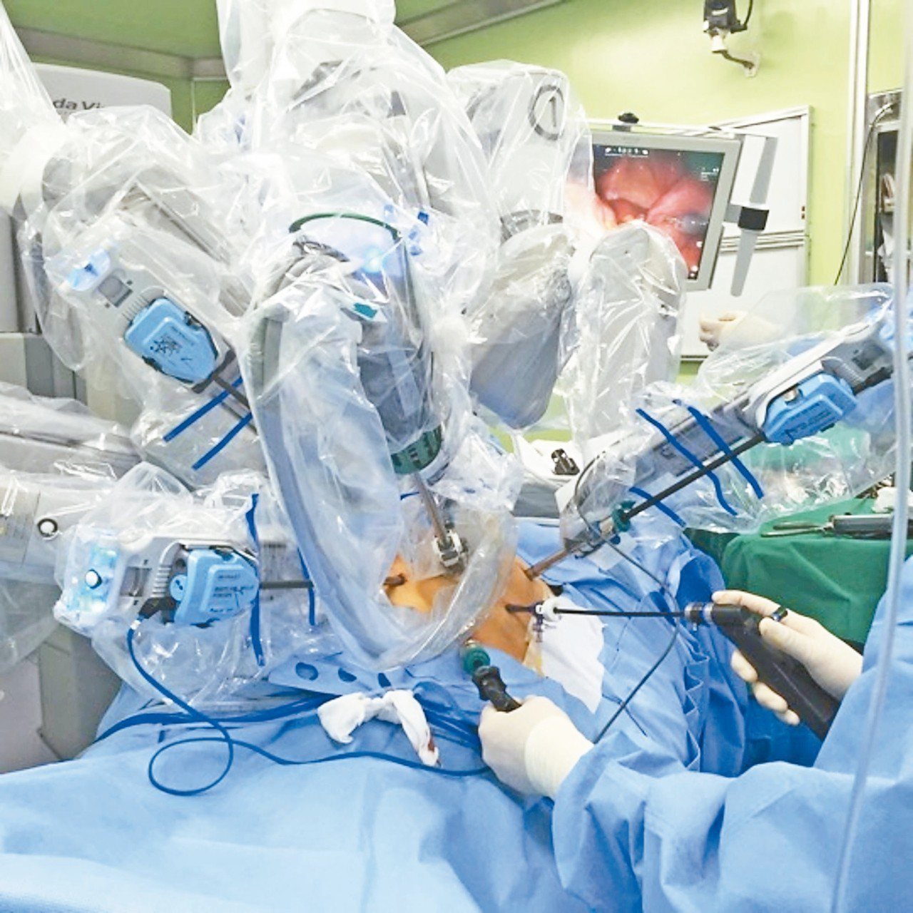機器手臂包上無菌套，確保細菌不掉到病人身上，並在狹小骨盆空間內切除腫瘤。