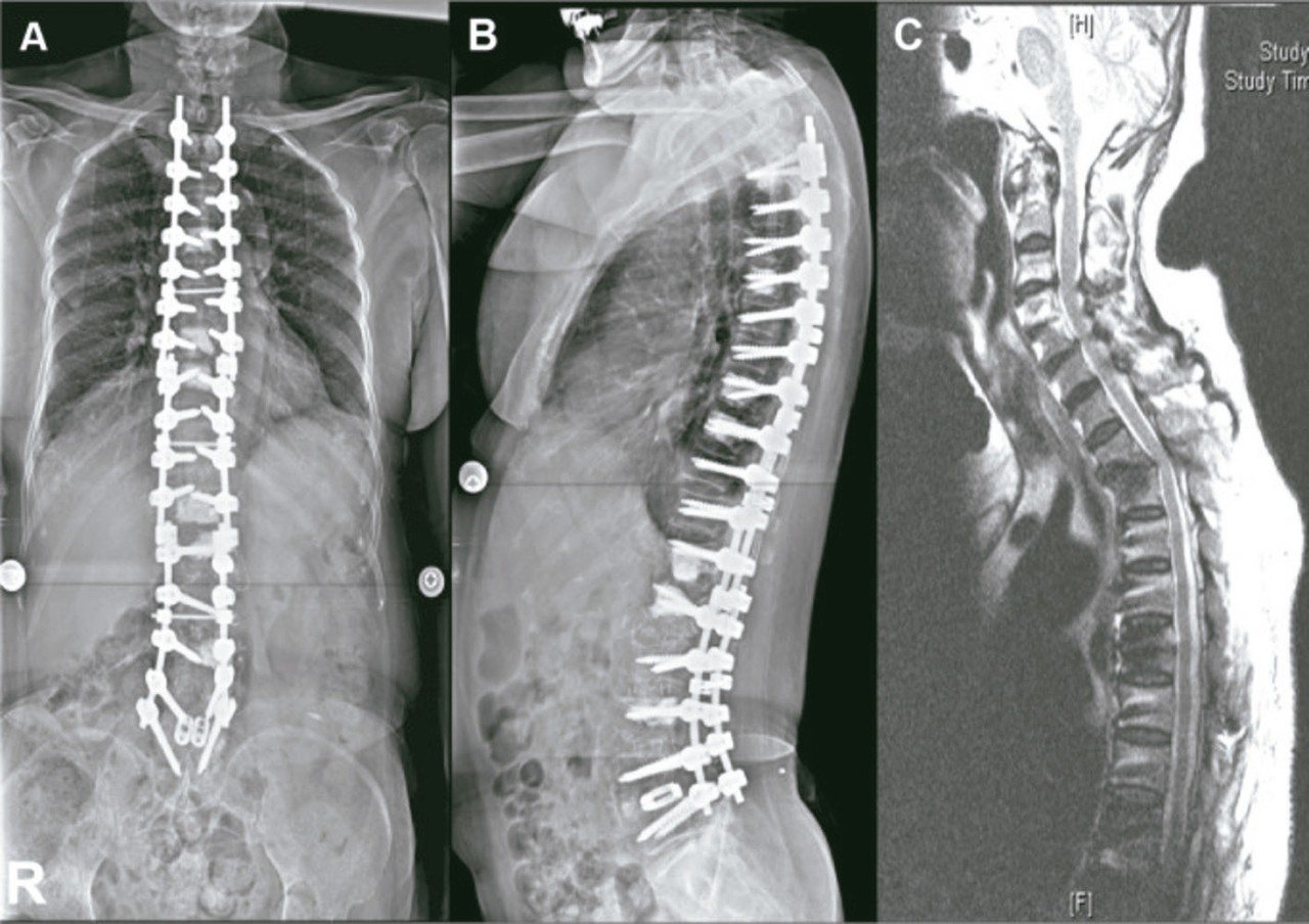 圖1 經多次手術，造成的超長節「開放性後側脊椎固定」與「骨融合手術」。