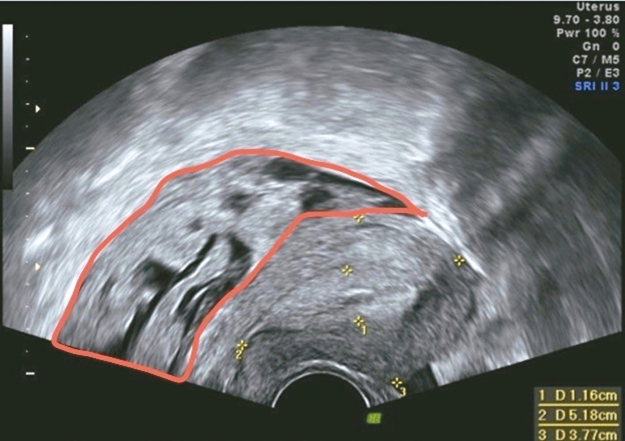 超音波影像顯示子宮直腸窩有不規則塊狀腫瘤，實際上是子宮內膜異位症。