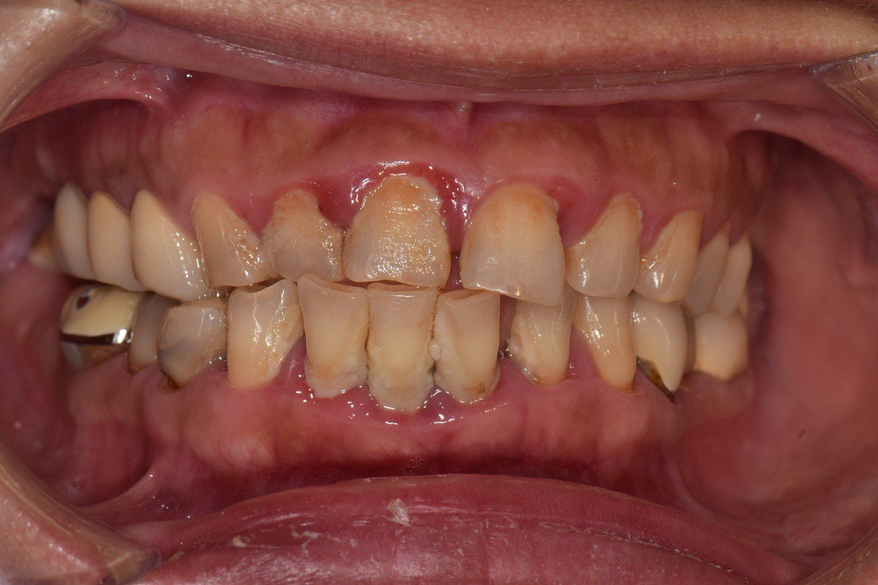 不要輕忽無聲無息的牙菌斑或牙結石！牙周病初期可能僅牙齦些許紅腫，一旦口腔衛生持續不佳，就可能帶來嚴重傷害。臺大醫院竹東分院／提供