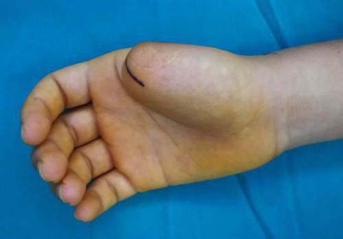 一名年輕人兒時因意外失去了手的大拇指，最近透過手術，取用腳趾進行手指再造。取自法...