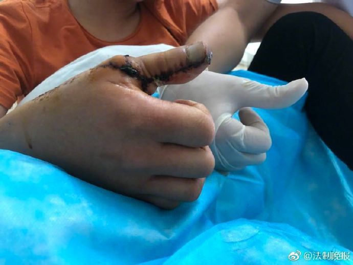一名年輕人兒時因意外失去了手的大拇指，最近透過手術，取用腳趾進行手指再造。取自法...