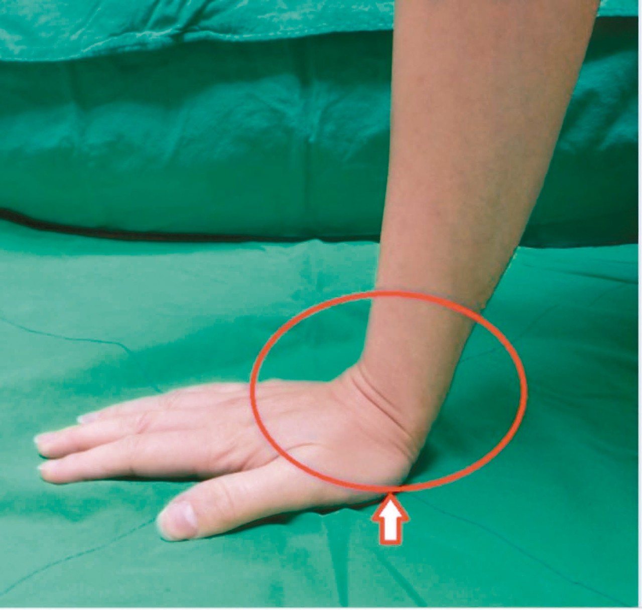 當跌倒意外發生時，人往往會反射性的以手撐地（圖1），手腕部位接受高度反折的碰撞力量造成骨折，即為遠端橈骨骨折，這是人體最常發生骨折的部位。
