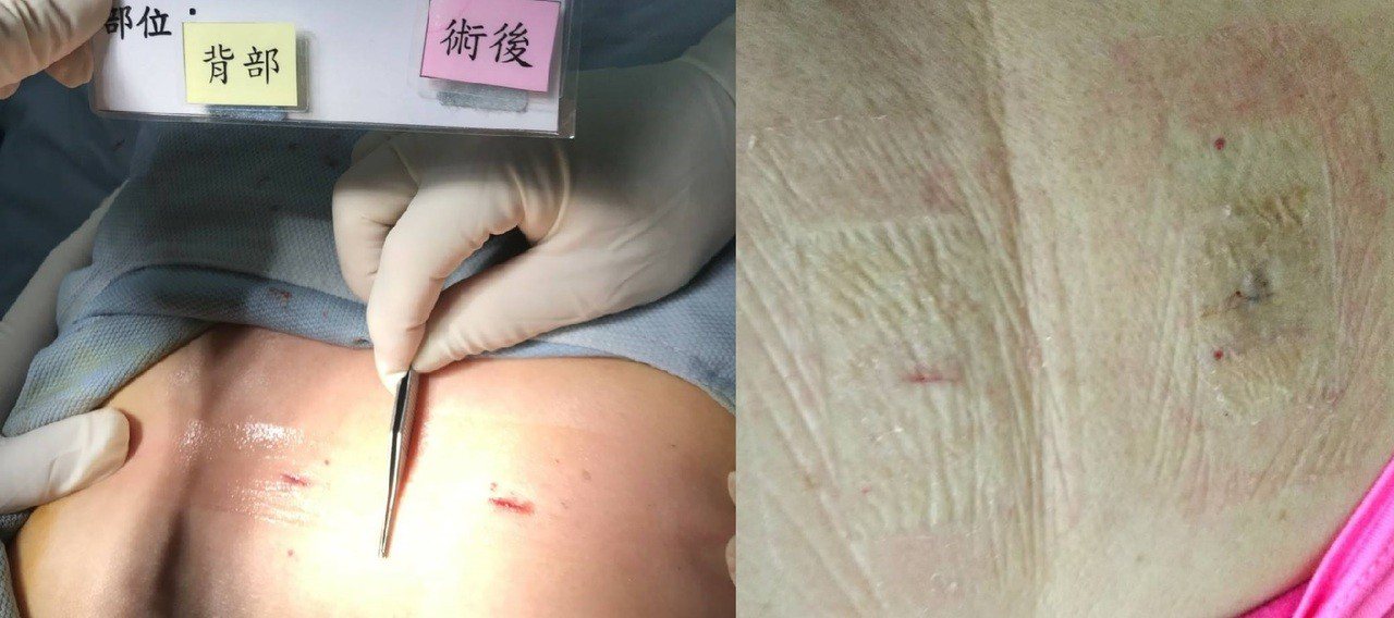 手術傷口照護有妙招，手術當天的傷口（圖左）及使用傷口三秒膠17天後的傷口（圖右），傷口順利癒合且外表平整美觀。照片／業者提供