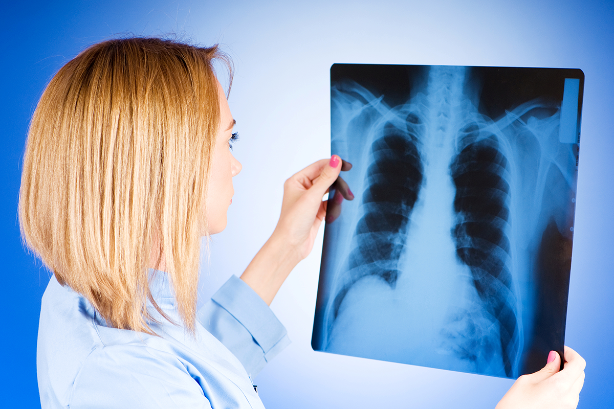 醫師建議55歲以上、有肺癌家族史、吸菸史等高危險群，可透過篩檢發現早期肺部病變。