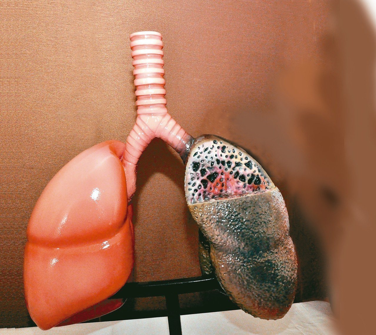 特發性肺纖維化患者晚期因肺泡壁組織纖維化，失去彈性，影響氣體交換，肺的外觀也像菜瓜布，被稱為「菜瓜布肺」。