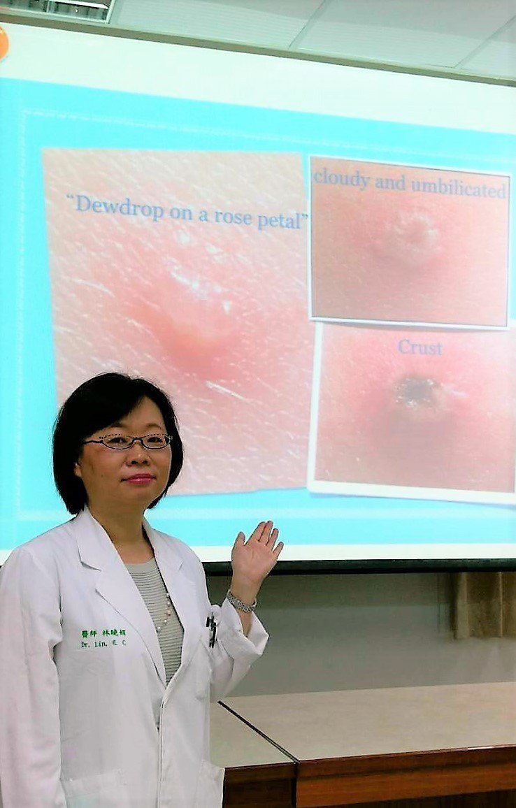 中國醫藥大學附設兒童醫院醫師林曉娟提醒，一定要讓幼兒按時接種水痘疫苗，以減少感染水痘的併發症以及帶狀疱疹的發生率和相關合併症。圖／中國醫藥大學附設兒童醫院提供