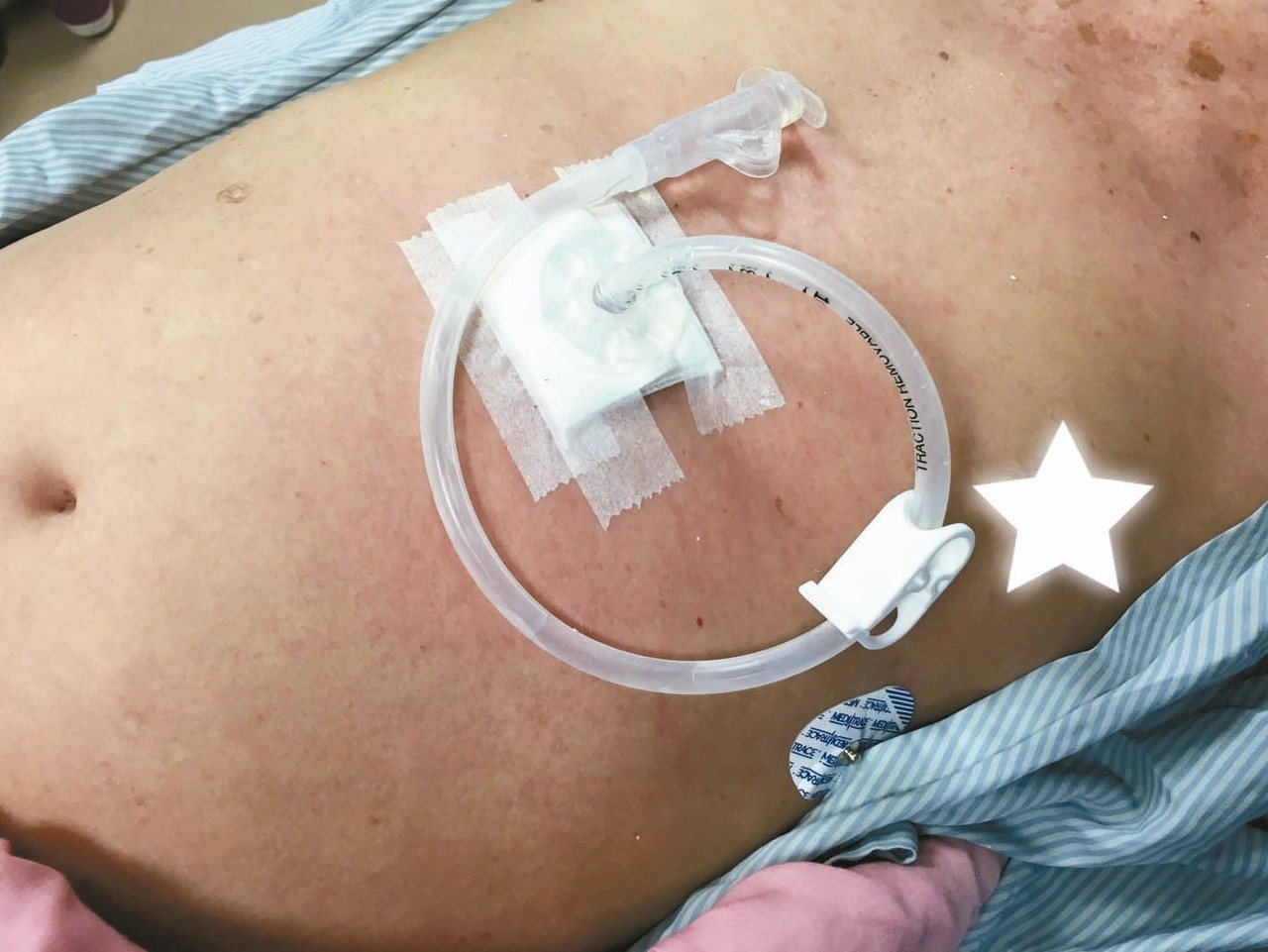 病患裝置在左上腹部的胃造口管，可方便管灌飲食。<br />圖／簡錫淵醫師提供