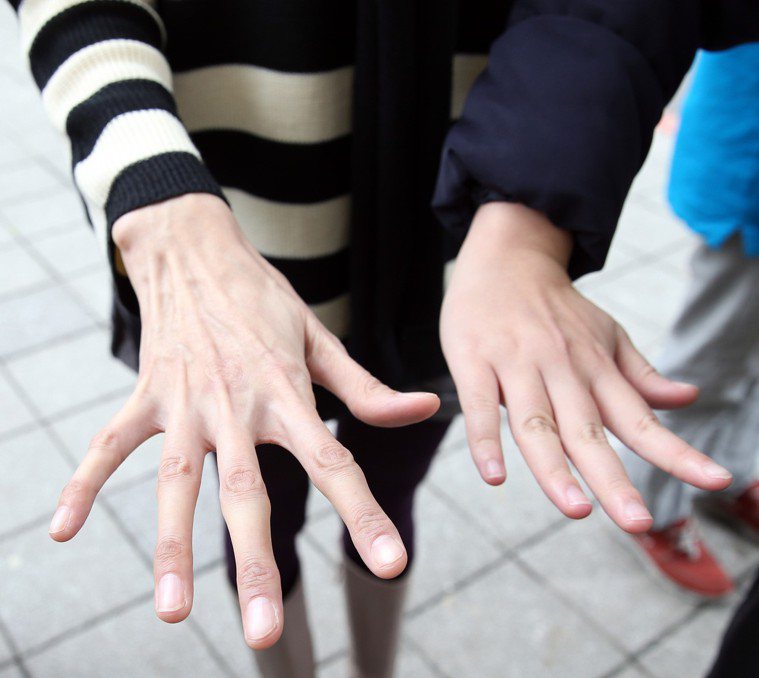 馬凡氏症患者的手（左）。 記者陳易辰／攝影 報系資料照