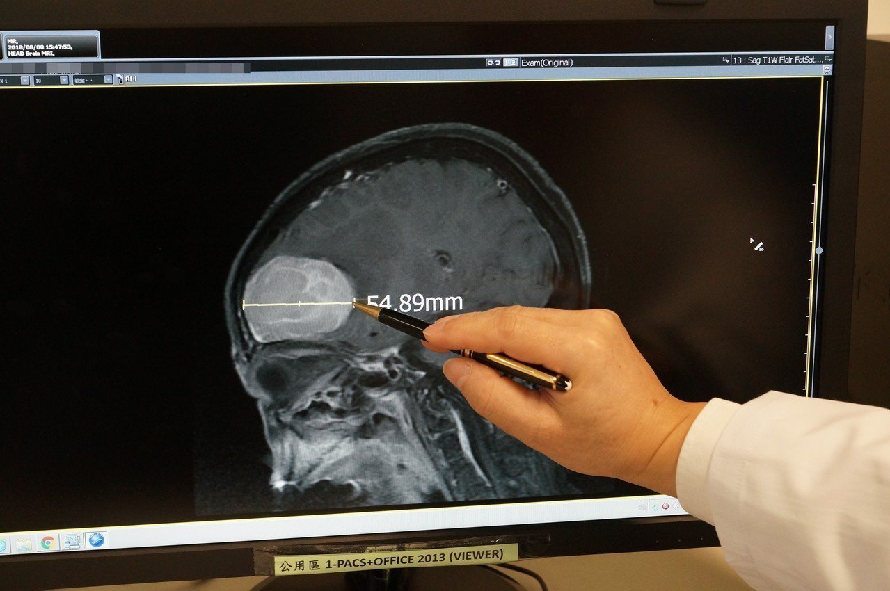 醫師手指處為婦人巨大腦瘤位置。圖／大林慈濟醫院提供