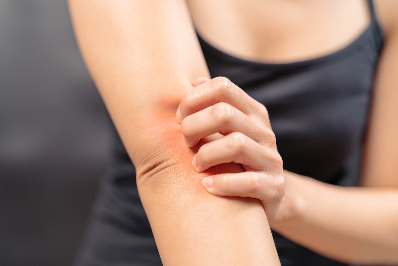 類天疱瘡的早期症狀是紅疹和搔癢，無論是胯下、腋下、關節等皮膚皺褶部位或其他部位，都有可能出現。