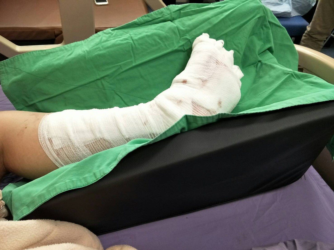 男童左腳掌被夾斷，童綜合醫院急救後，成功接回。圖／童醫院提供