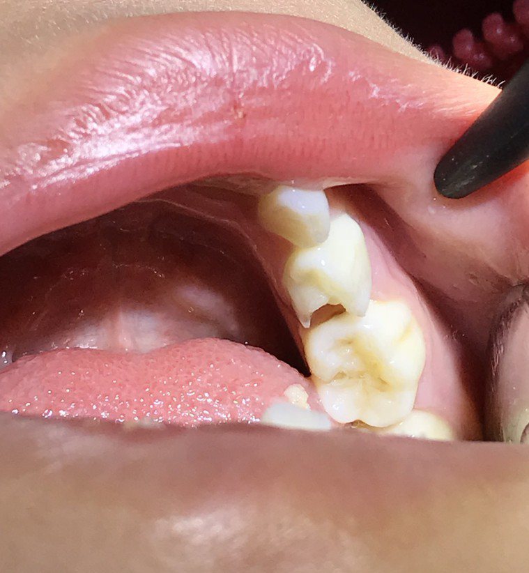 不少人過年作息不正常甚至暴飲暴食導致牙齒易出狀況，牙醫師以「紅黃綠」區別不同症狀...