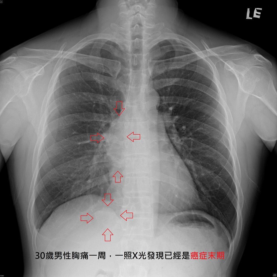 名醫蘇一峰診治一名30歲就癌末的病患，X光片可以看出癌症已經轉移。圖/蘇一峰提供