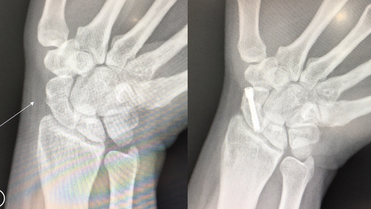 一名20多歲女性上班族路跑時不慎跌倒以手撐地，右手大拇指外側的舟狀骨竟發生骨折位移（圖左），卻在痛了4個月後才確診手術（圖右）。圖／活力得中山脊椎外科醫院提供
