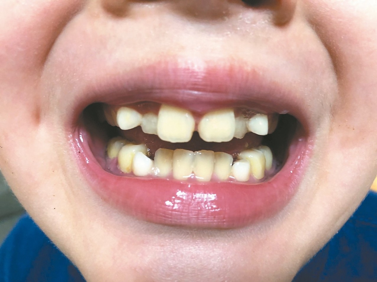 小朋友上顎過窄，使得牙齒排列不整、臉型「小下巴」等，是睡眠呼吸中止的高危險群。<br />記者劉嘉韻／攝影