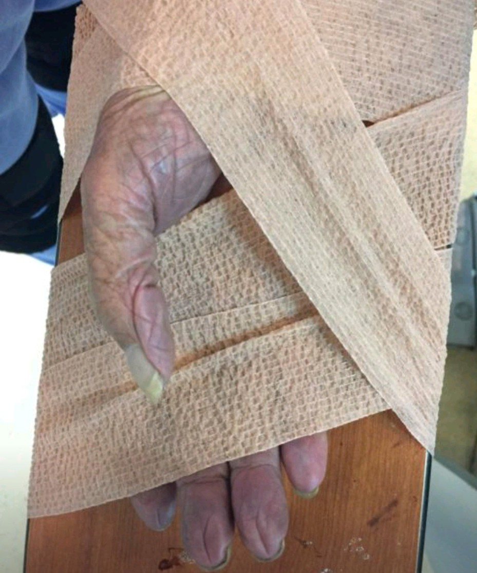 97歲老翁右手突然劇痛，慘白、發紫，原來是手中風。圖/奇美醫院提供