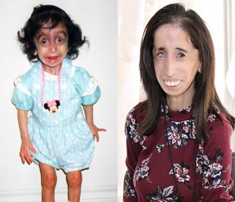 罕有罕見疾病的麗茲從小就被人投以異樣眼光，長大後還被貼上「世界最醜女人」的標籤。圖／（左）擷自dailymail、（右）擷自wikipedia，女子學提供
