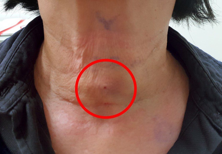 女子到醫院治療甲狀腺腫瘤，治療後脖子留下針扎痕跡。圖／光田綜合醫院提供